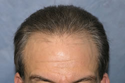 1 Year After Hair Transplantation