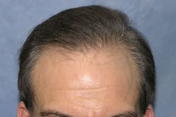 9 1/2 Months After Hair Transplant Surgery