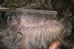 1 Week After 2nd Hair Transplant - Donor Area Closed with Staples