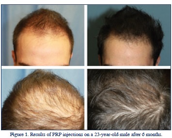 PRP Therapy Increases Hair Density