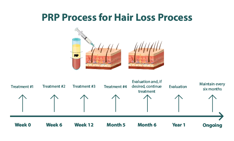 prp for hair loss treatment timeline