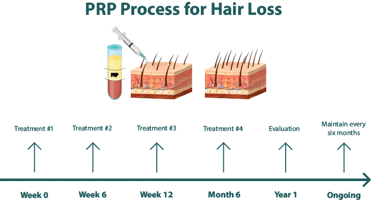 prp for hair loss treatment timeline