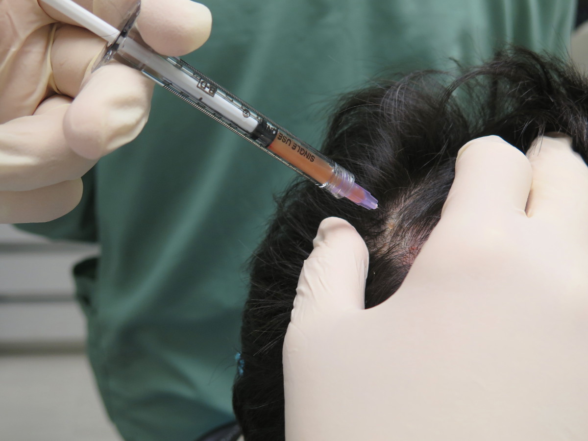 PRP for Hair Loss LongTerm Benefits