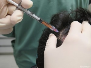 Platelet Rich Plasma (PRP) Treatment at Bernstein Medical