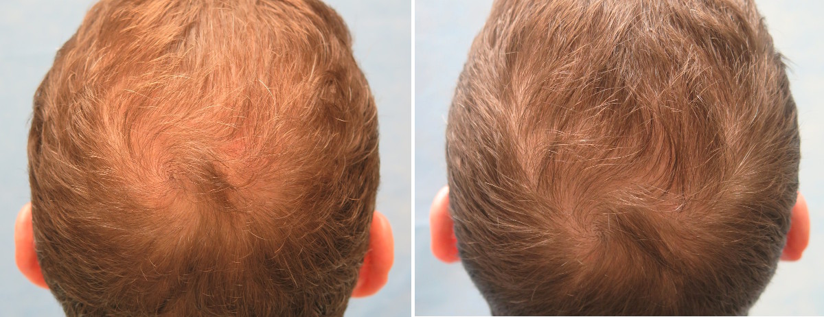 PRP for Hair Loss - Platelet Rich Plasma | Bernstein Medical PRP for Hair Loss - Platelet Rich Plasma | Bernstein Medical