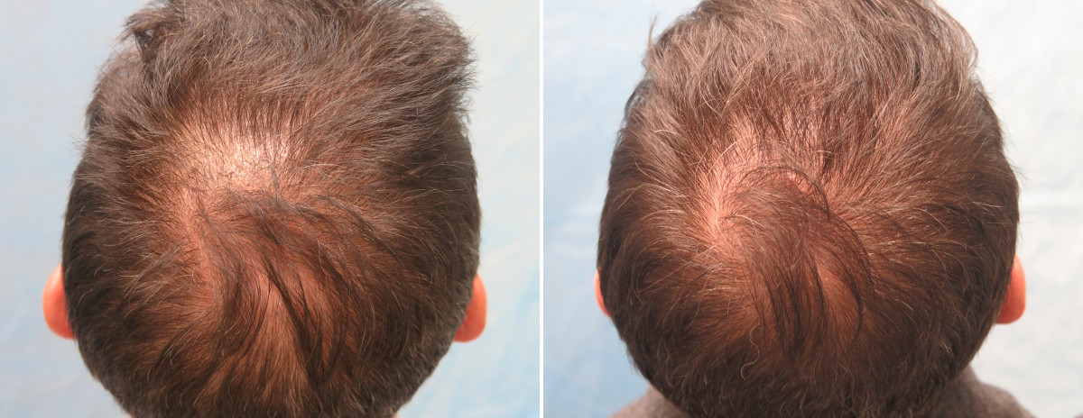 PRP Patient UMZ - Before and After