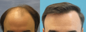 Side-by-side photos of a man showing hair restoration: sparse frontal hairline before and fuller hairline after treatment.