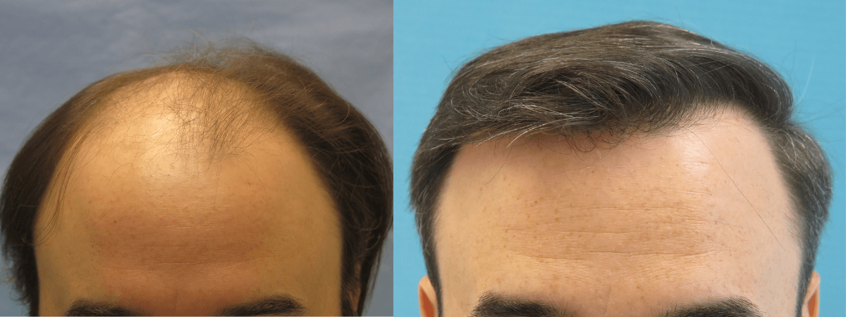 Bernstein Medical - Patient QRI Before and After Hair Transplant Photo