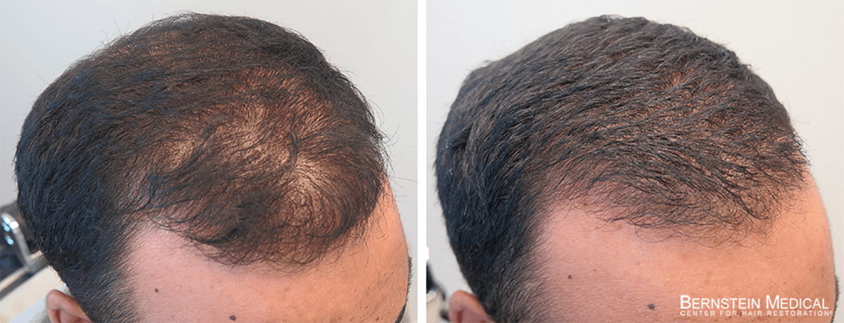 Propecia Rogaine Before After Photos | Medical