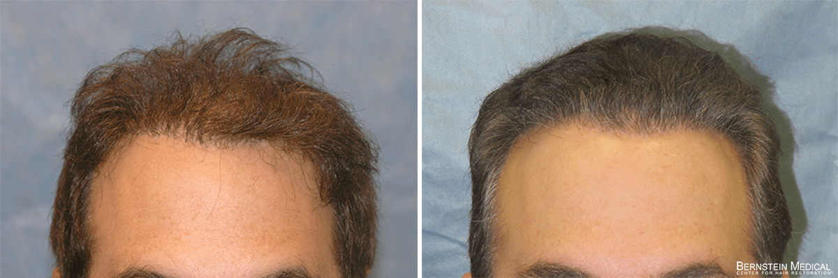 Bernstein Medical - Patient BIB Before and After Hair Transplant Photo 