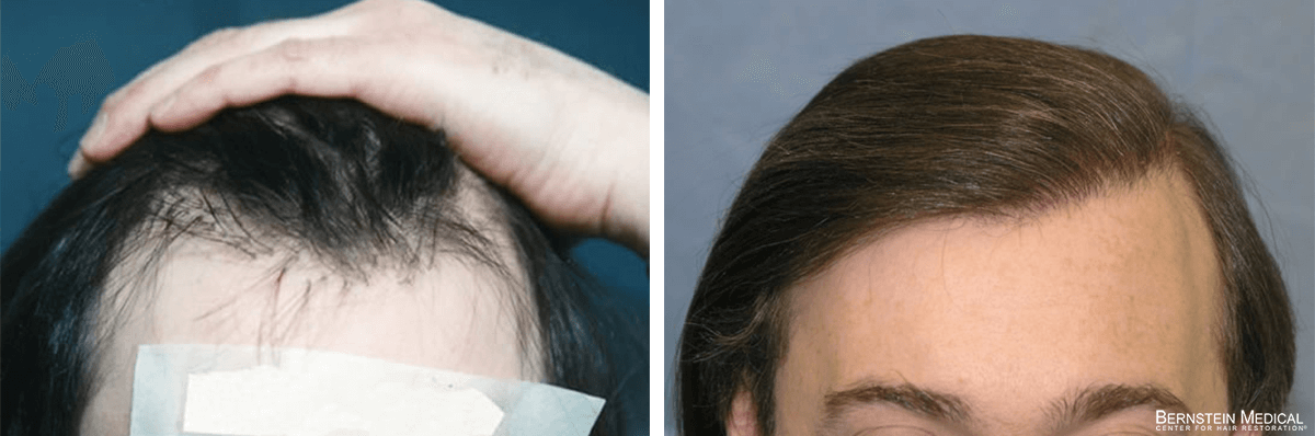Bernstein Medical - Patient BTI Before and After Hair Transplant Photo 
