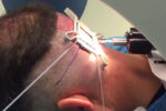 FUE Nomenclature changed to Follicular Unit Excision