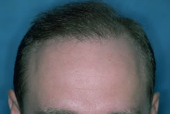 After Hair Restoration