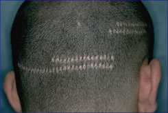 Scars from Punch-Graft Technique