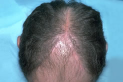 Y-Shaped Scar from Scalp Reduction