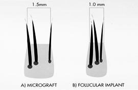 Patient Evaluation and Surgical Planning - Figure 1. Micrografting vs. Follicular Transplantation