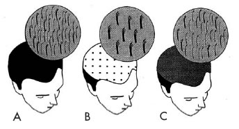 Patient Evaluation and Surgical Planning - Figure 2. Hair Density