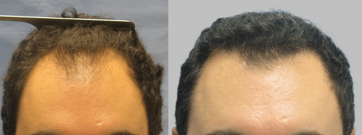 Bernstein Medical - Patient UDF Before and After Hair Transplant Photo