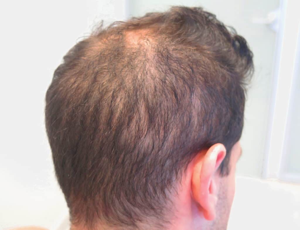 Classification of Hair Loss in Men Bernstein Medical