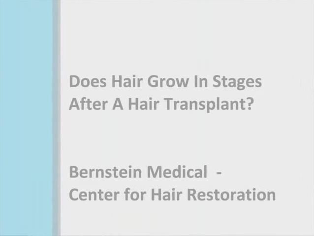 Does Hair Grow In Stages After Hair Transplant?