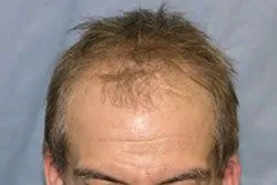 After hair transplant