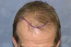 Before hair transplant