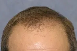 After hair transplant