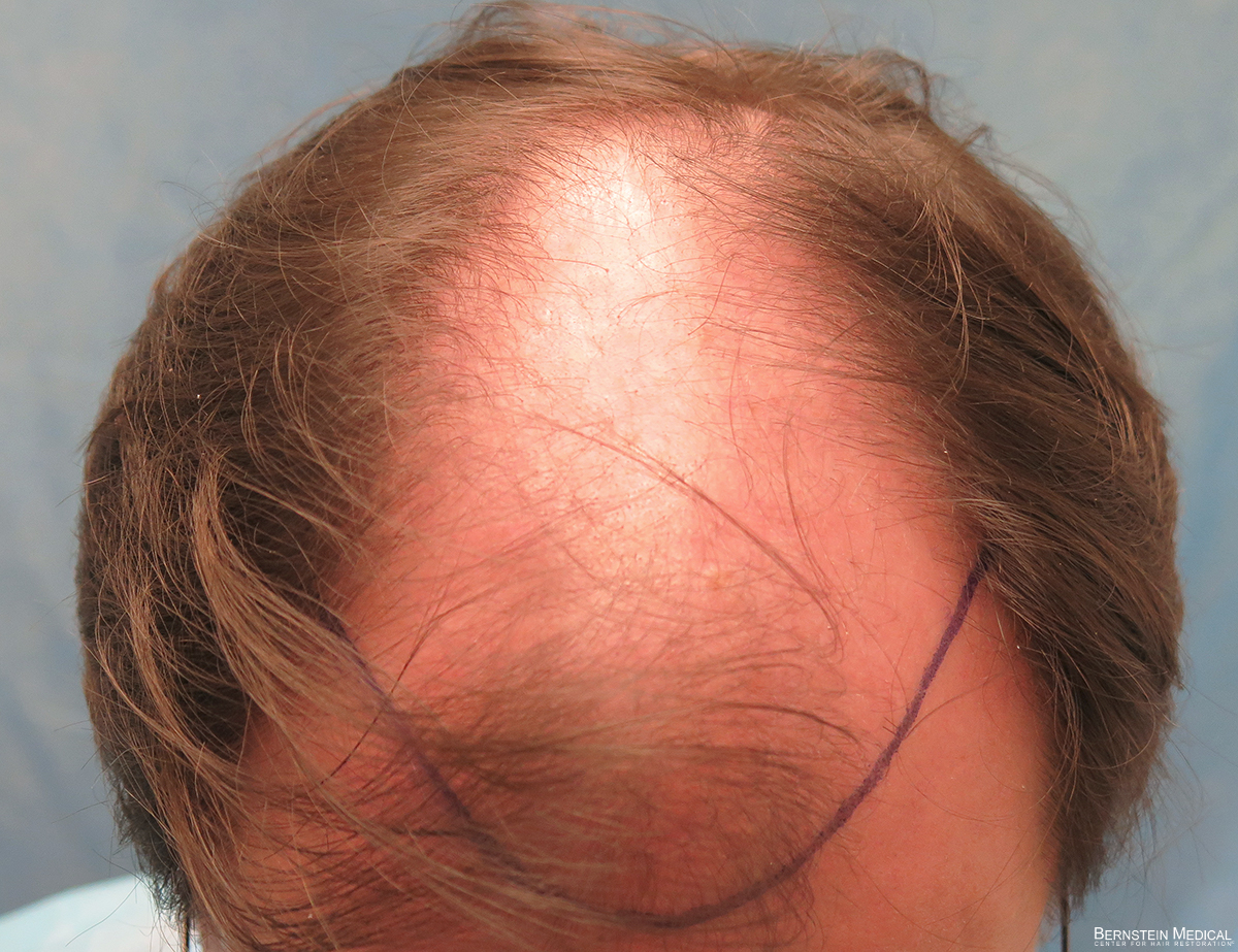 2b_planned-hairline_top-view_jyc.jpg