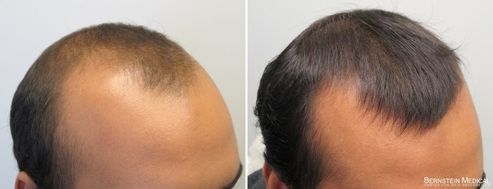 Propecia Rogaine Before After Photos Bernstein Medical Patient Ibn