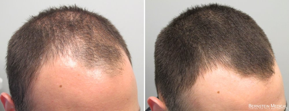 foam and finasteride rogaine
