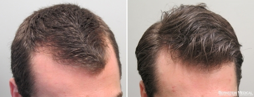 Patient LMC, a 27 y/o male before treatment (left) and after 5 months on Rogaine (minoxidil) solution 5% PM (right)