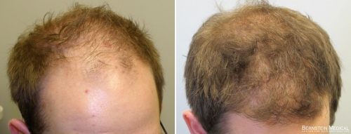 Patient OVQ, a 28 y/o male before treatment (left) and after 1 year on finasteride 1.25mg/day and Rogaine (minoxidil) solution 5% PM (right)