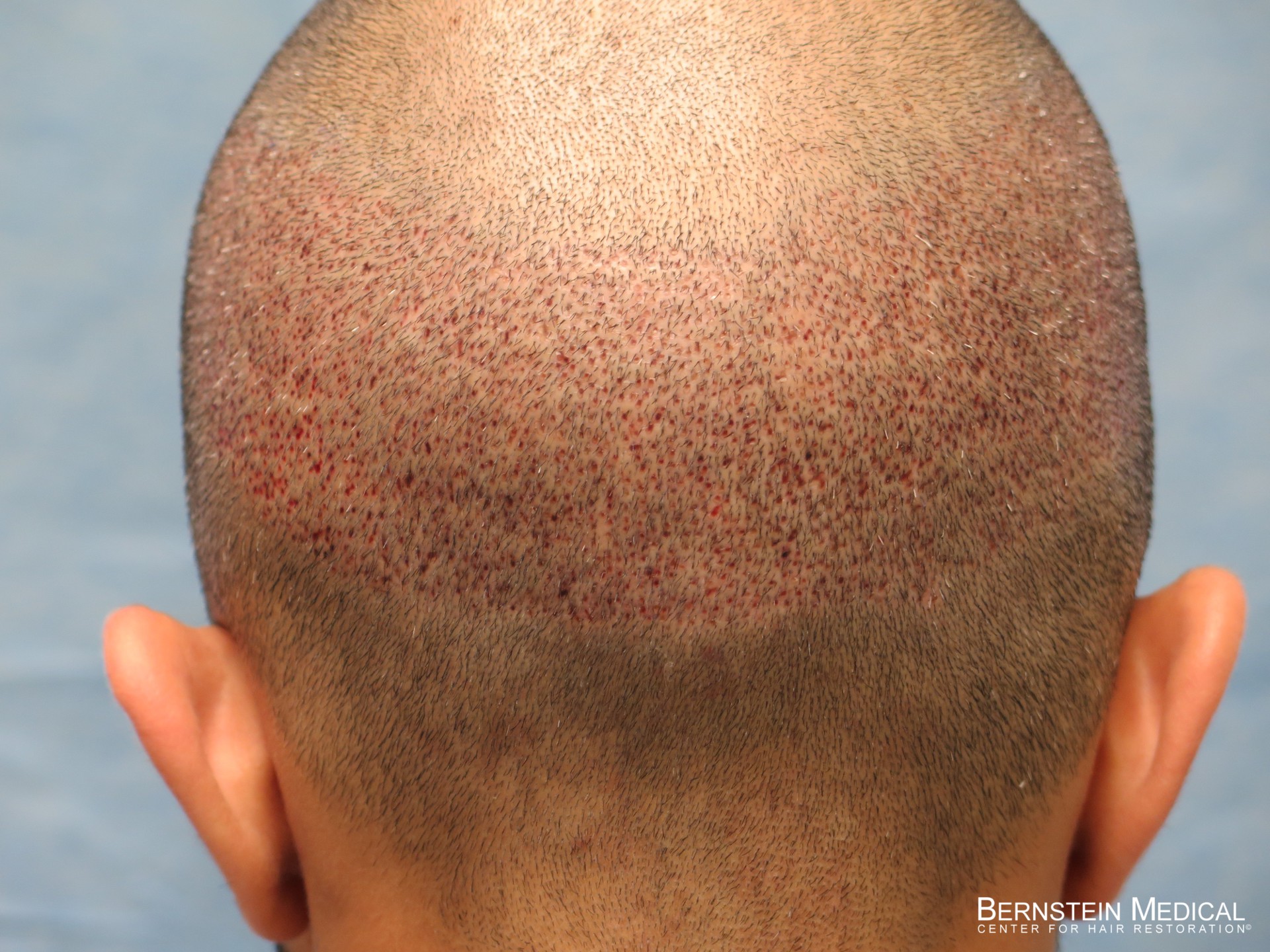FUE Hair Transplant Donor Area Healing | Bernstein Medical FUE Hair Transplant Donor Area Healing | Bernstein Medical