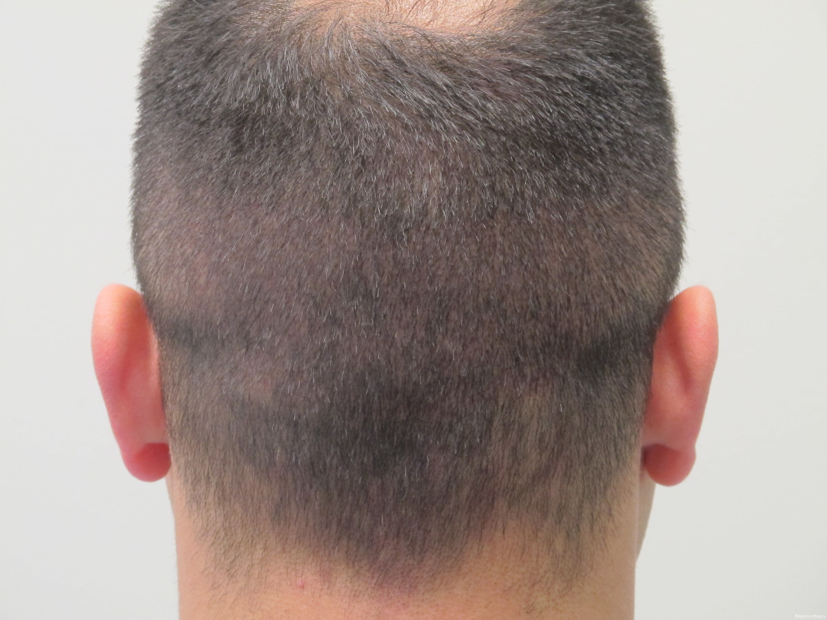 Best Hair Transplant Clinic in Bhubaneswar - Low-cost Hair Treatment | Hair Doctors Best Hair Transplant Clinic in Bhubaneswar - Low-cost Hair Treatment | Hair Doctors