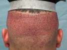 R-FUE of 1,891 Grafts