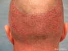 Day 2 of 2-Day R-FUE - 2,768 Grafts