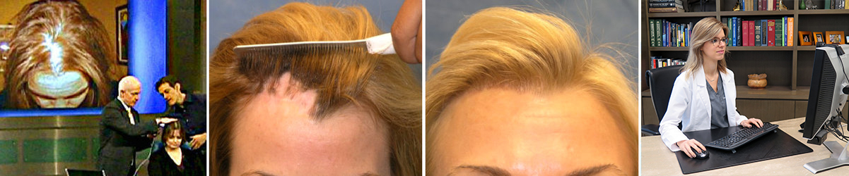Hair Loss in Women