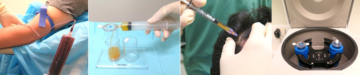 Platelet Rich Plasma (PRP) for Hair Loss
